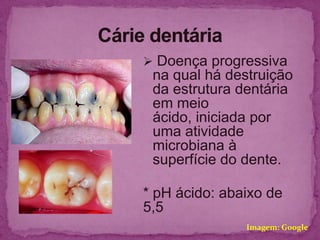  Doença progressiva
 na qual há destruição
 da estrutura dentária
 em meio
 ácido, iniciada por
 uma atividade
 microbiana à
 superfície do dente.

* pH ácido: abaixo de
5,5
               Imagem: Google
 