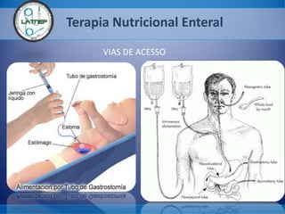 Terapia Nutricional Enteral
VIAS DE ACESSO
 