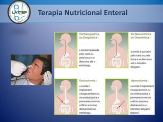 Terapia Nutricional Enteral
 