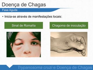 • Inicia-se através de manifestações locais:
Doença de Chagas
Trypanosoma cruzi e Doença de Chagas
Fase Aguda
Sinal de Romaña Chagoma de inoculação
 