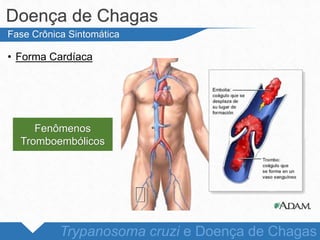 • Forma Cardíaca
Doença de Chagas
Trypanosoma cruzi e Doença de Chagas
Fase Crônica Sintomática
Fenômenos
Tromboembólicos
 