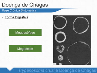 • Forma Digestiva
Doença de Chagas
Trypanosoma cruzi e Doença de Chagas
Fase Crônica Sintomática
Megaesôfago
Megacólon
 