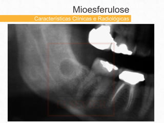 Mioesferulose
Características Clínicas e Radiológicas
 