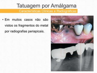 • Em muitos casos não são
vistos os fragmentos do metal
por radiografias periapicais.
Tatuagem por Amálgama
Características Clínicas e Radiográficas
 