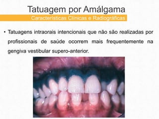 • Tatuagens intraorais intencionais que não são realizadas por
profissionais de saúde ocorrem mais frequentemente na
gengiva vestibular supero-anterior.
Tatuagem por Amálgama
Características Clínicas e Radiográficas
 
