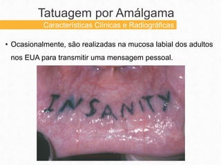 • Ocasionalmente, são realizadas na mucosa labial dos adultos
nos EUA para transmitir uma mensagem pessoal.
Tatuagem por Amálgama
Características Clínicas e Radiográficas
 
