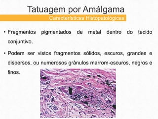 • Fragmentos pigmentados de metal dentro do tecido
conjuntivo.
• Podem ser vistos fragmentos sólidos, escuros, grandes e
dispersos, ou numerosos grânulos marrom-escuros, negros e
finos.
Tatuagem por Amálgama
Características Histopatológicas
 