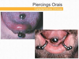 Piercings Orais
Características Clínicas
 