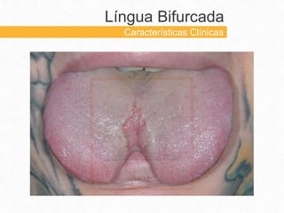 Língua Bifurcada
Características Clínicas
 