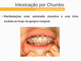 • Manifestações orais: estomatite ulcerativa e uma linha
azulada ao longo da gengiva marginal.
Intoxicação por Chumbo
Características Clínicas
 