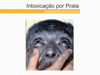 Intoxicação por Prata
Características Clínicas
 