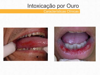 Intoxicação por Ouro
Características Clínicas
 