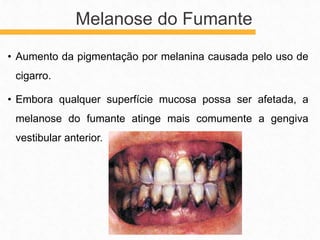 • Aumento da pigmentação por melanina causada pelo uso de
cigarro.
• Embora qualquer superfície mucosa possa ser afetada, a
melanose do fumante atinge mais comumente a gengiva
vestibular anterior.
Melanose do Fumante
 