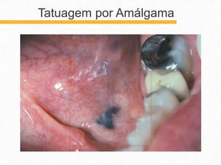 Tatuagem por Amálgama
 