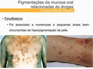 • Fenolftaleína
• Foi associado a numerosas e pequenas áreas bem-
circunscritas de hiperpigmentação da pele.
Pigmentações da mucosa oral
relacionadas às drogas
Características Clínicas
 