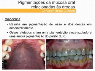 • Minociclina
• Resulta em pigmentação do osso e dos dentes em
desenvolvimento.
• Ossos afetados criam uma pigmentação cinza-azulado e
uma ampla pigmentação do palato duro.
Pigmentações da mucosa oral
relacionadas às drogas
Características Clínicas
 