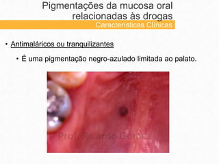 • Antimaláricos ou tranquilizantes
• É uma pigmentação negro-azulado limitada ao palato.
Pigmentações da mucosa oral
relacionadas às drogas
Características Clínicas
 