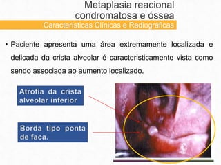 • Paciente apresenta uma área extremamente localizada e
delicada da crista alveolar é caracteristicamente vista como
sendo associada ao aumento localizado.
Metaplasia reacional
condromatosa e óssea
Características Clínicas e Radiográficas
 