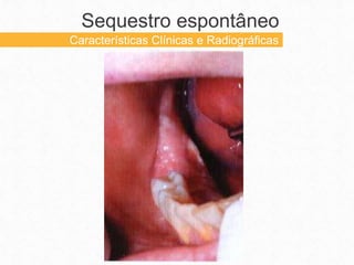 Sequestro espontâneo
Características Clínicas e Radiográficas
 