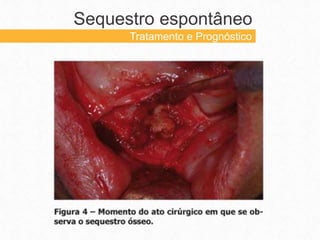 Sequestro espontâneo
Tratamento e Prognóstico
 