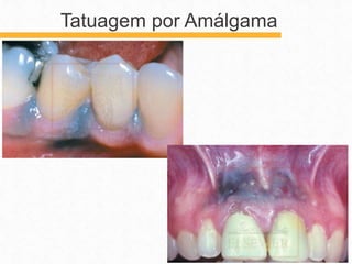 Tatuagem por Amálgama
 