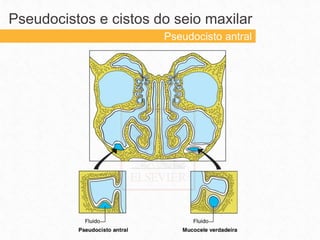 Pseudocistos e cistos do seio maxilar
Pseudocisto antral
 