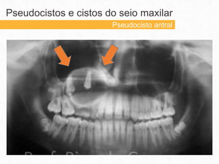 Pseudocistos e cistos do seio maxilar
Pseudocisto antral
 