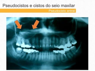 Pseudocistos e cistos do seio maxilar
Pseudocisto antral
 