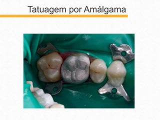 Tatuagem por Amálgama
 