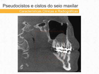 Pseudocistos e cistos do seio maxilar
Características Clínicas e Radiográficas
 