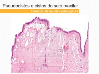 Pseudocistos e cistos do seio maxilar
Características Histopatológicas
 