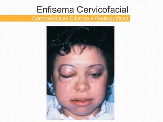 Enfisema Cervicofacial
Características Clínicas e Radiográficas
 