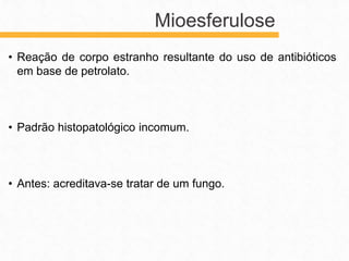 • Reação de corpo estranho resultante do uso de antibióticos
em base de petrolato.
• Padrão histopatológico incomum.
• Antes: acreditava-se tratar de um fungo.
Mioesferulose
 