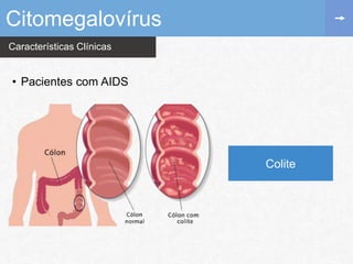 Características Clínicas
Citomegalovírus
• Pacientes com AIDS
Colite
 