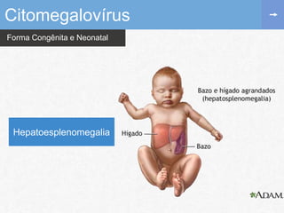 Forma Congênita e Neonatal
Citomegalovírus
Hepatoesplenomegalia
 
