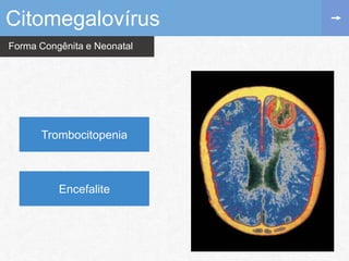 Forma Congênita e Neonatal
Citomegalovírus
Trombocitopenia
Encefalite
 