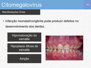 Manifestações Orais
• Infecção neonatal/congênita pode produzir defeitos no
desenvolvimento dos dentes.
Citomegalovírus
Hipoplasia difusa de
esmalte
Atrição
Hipomaturação do
esmalte
 