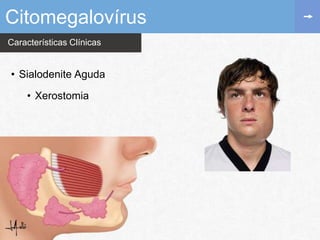 Características Clínicas
Citomegalovírus
• Sialodenite Aguda
• Xerostomia
 