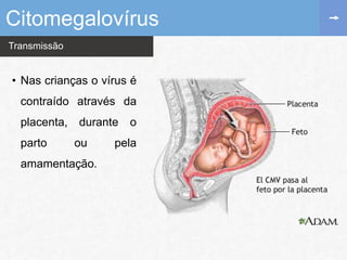 Transmissão
• Nas crianças o vírus é
contraído através da
placenta, durante o
parto ou pela
amamentação.
Citomegalovírus
 