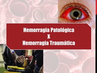 Hemorragia Patológica
X
Hemorragia Traumática
 