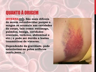QUANTOÀORIGEM
INTERNA São mais difíceis
de serem reconhecidas porque o
sangue se acumula nas cavidades
do corpo, tais como: estômago,
pulmões, bexiga, cavidades
craniana, torácica, abdominal e
etc.; e pode ser devido a lesões
traumáticas de vísceras.
Dependendo da gravidade, pode
exteriorizar-se pelos orifícios
(nariz,boca...)
 
