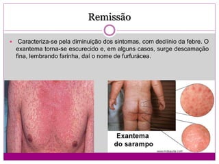 Remissão
 Caracteriza-se pela diminuição dos sintomas, com declínio da febre. O
exantema torna-se escurecido e, em alguns casos, surge descamação
fina, lembrando farinha, daí o nome de furfurácea.
 