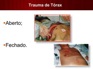 Trauma de Tórax
Aberto;
Fechado.
 