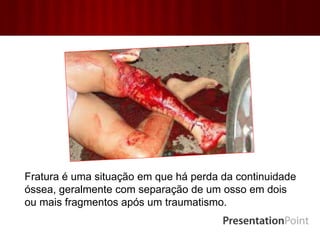 Fratura é uma situação em que há perda da continuidade
óssea, geralmente com separação de um osso em dois
ou mais fragmentos após um traumatismo.
 