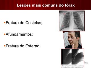 Lesões mais comuns do tórax
Fratura de Costelas;
Afundamentos;
Fratura do Externo.
 