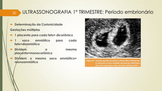  Determinação da Corionicidade
Gestações múltiplas
 1 placenta para cada feto= dicoriônico
 1 saco amniótico para cada
feto=diamniótico
 Dividem a mesma
placenta=monocoriônico
 Dividem o mesmo saco amniótico=
monoamniótico
20 ULTRASSONOGRAFIA 1° TRIMESTRE: Período embrionário
 