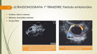  Ovários, útero e anexos
 Miomas, anomalias uterinas
 Corpo lúteo
22 ULTRASSONOGRAFIA 1° TRIMESTRE: Período embrionário
 