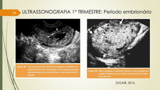 24
ZUGAIB, 2016.
ULTRASSONOGRAFIA 1° TRIMESTRE: Período embrionário
 