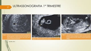 27
ZUGAIB, 2016.
ULTRASSONOGRAFIA 1° TRIMESTRE
 