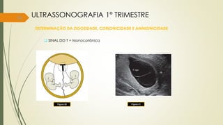 36
DETERMINAÇÃO DA ZIGOZIDADE, CORIONICIDADE E AMNIONICIDADE
 SINAL DO T = Monocoriônica
Figura 20
ULTRASSONOGRAFIA 1° TRIMESTRE
Figura 21
 